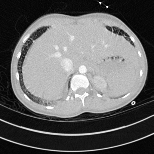 Bronchogenic cyst (Radiopaedia 77801-90071 Axial lung window 79).jpg