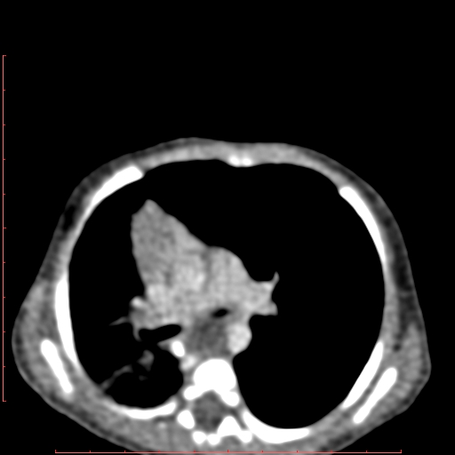 Bronchogenic cyst (Radiopaedia 78599-91409 B 93).jpg