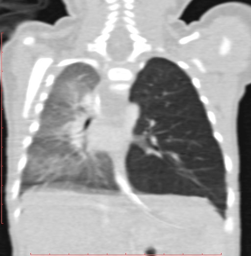 Bronchogenic cyst (Radiopaedia 78599-91409 Coronal lung window 144).jpg