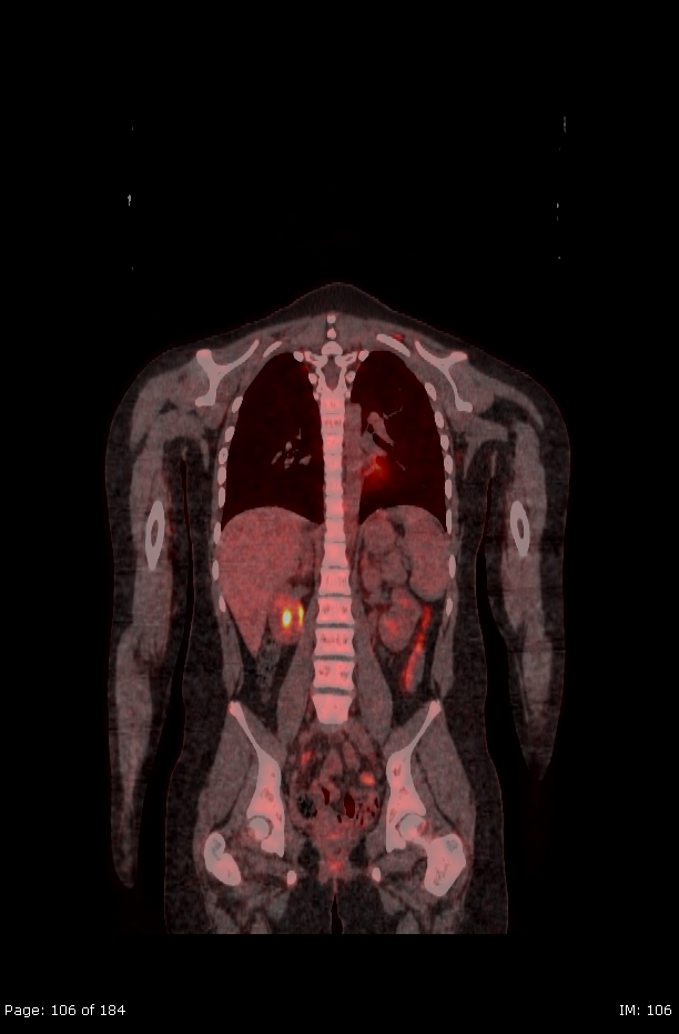 Brown fat uptake (FDG PET-CT) (Radiopaedia 77392-89513 Fused coronal 64).jpg