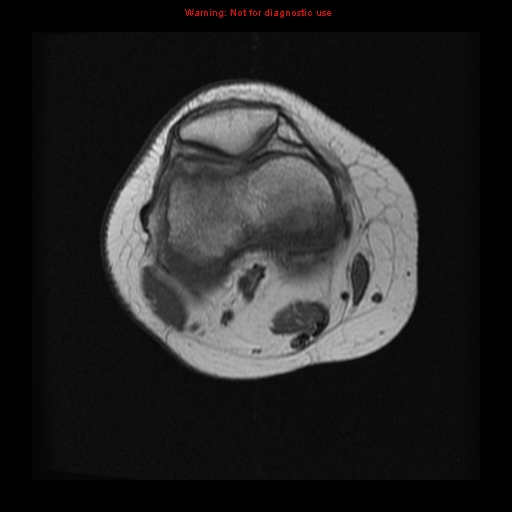 File:Brown tumor (Radiopaedia 12318-12597 Axial T1 4).jpg