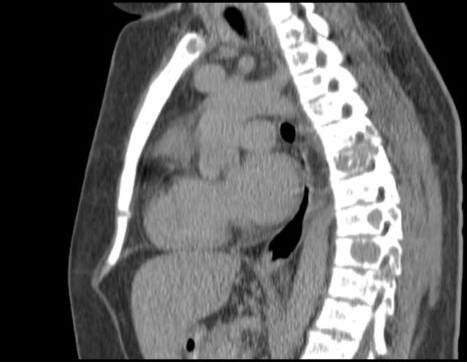 Brown tumors compressing the spinal cord (Radiopaedia 68442-77988 B 32).jpg