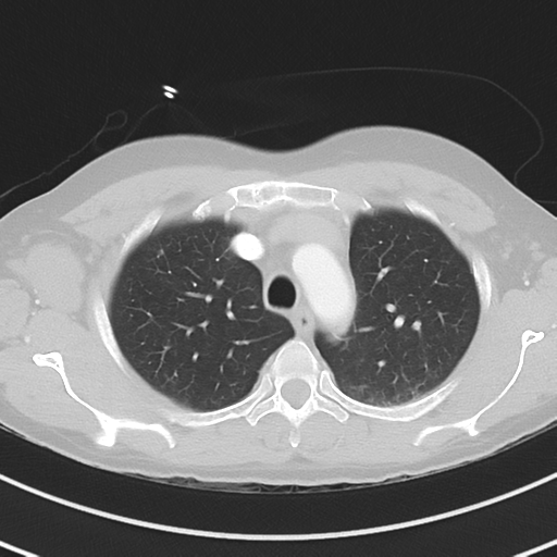 Burkitt lymphoma (Radiopaedia 34686-36121 Axial lung window 13).png