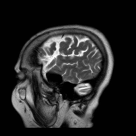 File:Burnt-out meningioma (Radiopaedia 51557-57336 Sagittal T2 3).jpg