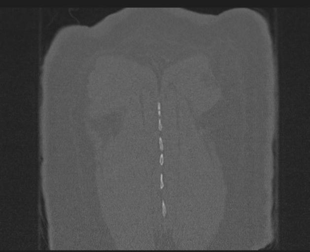 File:Burst fracture - thoracic spine (Radiopaedia 30238-30865 Coronal bone window 152).jpg