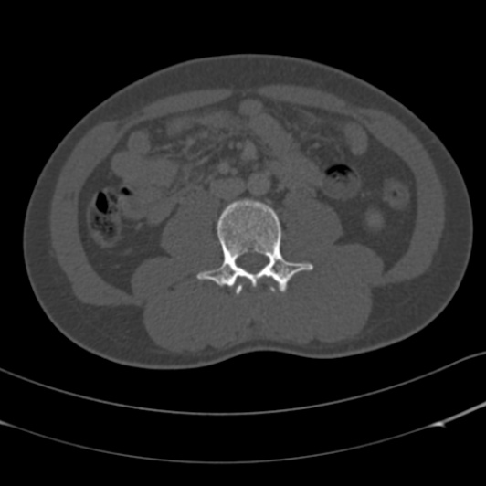 Burst fracture with cauda equina syndrome (Radiopaedia 25701-25867 Axial bone window 93).jpg