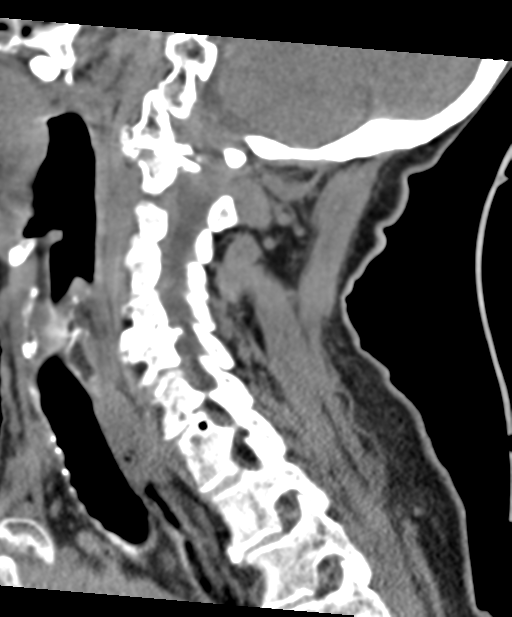 C2 fracture with vertebral artery dissection (Radiopaedia 37378-39199 D 32).png