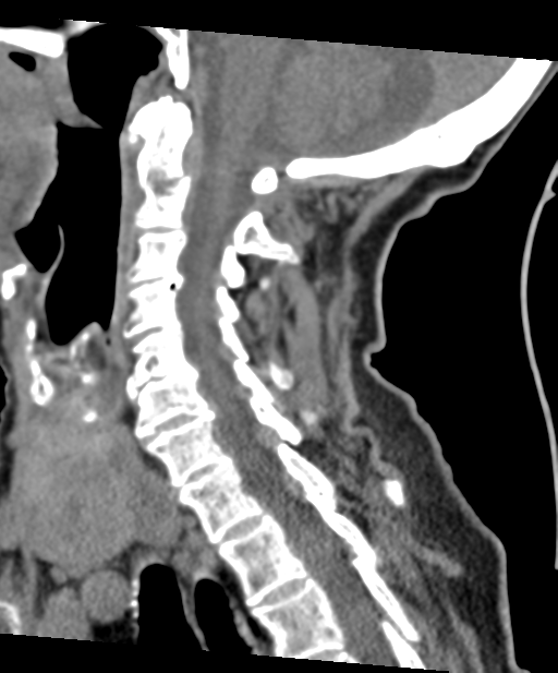 C2 fracture with vertebral artery dissection (Radiopaedia 37378-39199 D 43).png