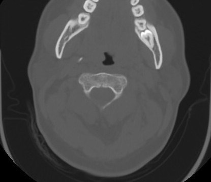 C7 laminar fracture and Klippel-Feil syndrome (Radiopaedia 86710-102850 Axial bone window 29).jpg