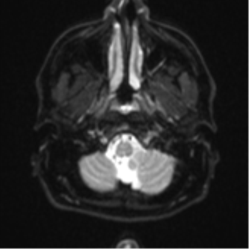 File:CNS vasculitis (Radiopaedia 55715-62263 Axial DWI 3).png