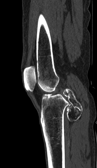 Calcified hematoma - popliteal fossa (Radiopaedia 63938-72763 Sagittal bone window 42).jpg