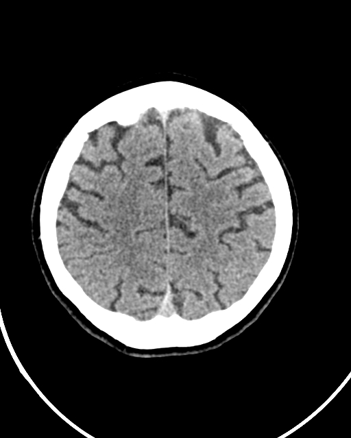 Calcified meningioma (Radiopaedia 74361-85243 Axial non-contrast 13).jpg