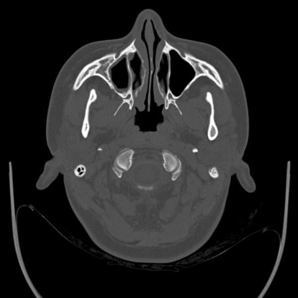 Calvarial osteoma (Radiopaedia 36520-38079 Axial bone window 9).jpg