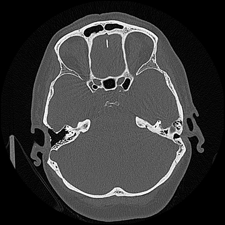 Canal up mastoidectomy (Radiopaedia 78108-90638 Axial bone window 100).jpg