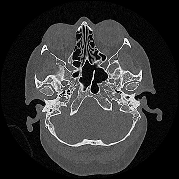 Canal up mastoidectomy (Radiopaedia 78108-90638 Axial bone window 42).jpg
