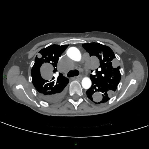 Cannonball metastases (Radiopaedia 82110-96150 Axial C+ CTPA 124).jpg