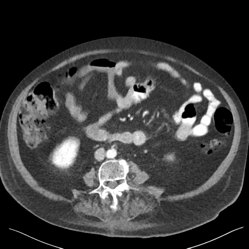 Cannonball metastases from endometrial cancer (Radiopaedia 42003-45031 E 42).png