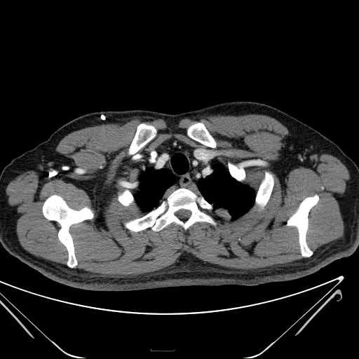 File:Cannonball pulmonary metastases (Radiopaedia 67684-77101 D 29).jpg