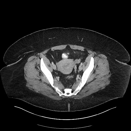 Carcinoid tumor - terminal ileum (Radiopaedia 60931-68739 A 111).jpg