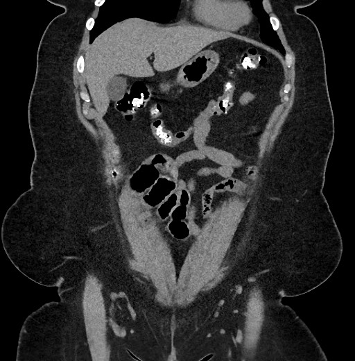 Carcinoid tumor - terminal ileum (Radiopaedia 60931-68740 Coronal non-contrast 21).jpg