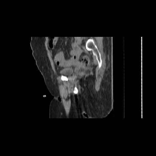 File:Carcinoma cervix- brachytherapy applicator (Radiopaedia 33135-34173 D 56).jpg
