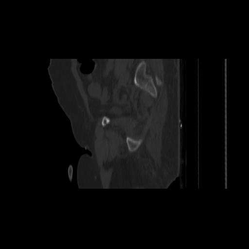 Carcinoma cervix- brachytherapy applicator (Radiopaedia 33135-34173 Sagittal bone window 140).jpg