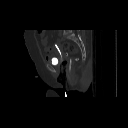 File:Carcinoma cervix- brachytherapy applicator (Radiopaedia 33135-34173 Sagittal bone window 84).jpg