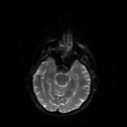 Carcinoma ex-pleomorphic adenoma of parotid (Radiopaedia 28383-28627 Ax DWI B-500 GE 30).jpg