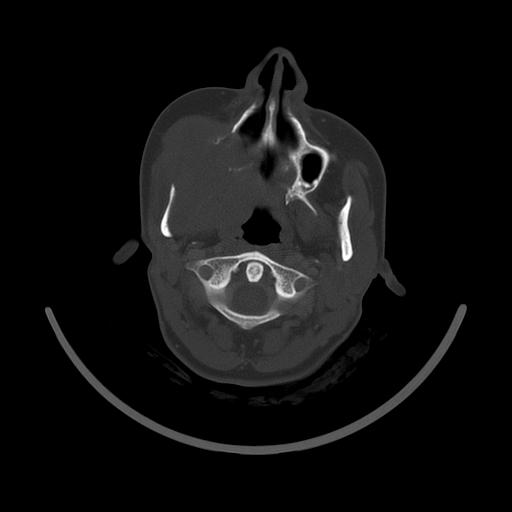 Carcinoma of the maxillary antrum (Radiopaedia 53805-59888 Axial bone window 64).jpg