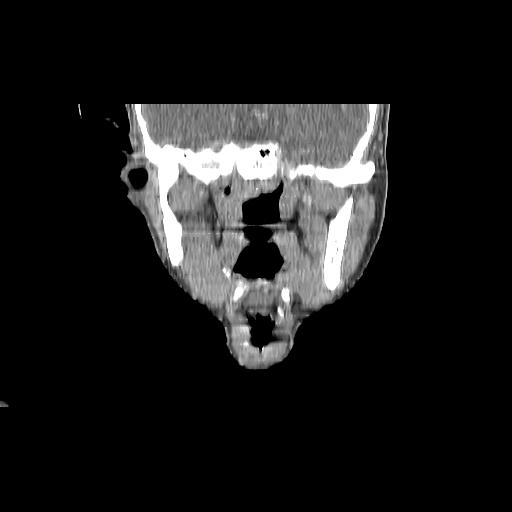 Carcinoma of the maxillary antrum (Radiopaedia 53805-59888 Coronal C+ delayed 82).jpg