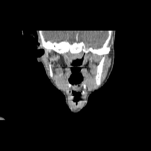 Carcinoma of the maxillary antrum (Radiopaedia 53805-59888 Coronal C+ delayed 84).jpg