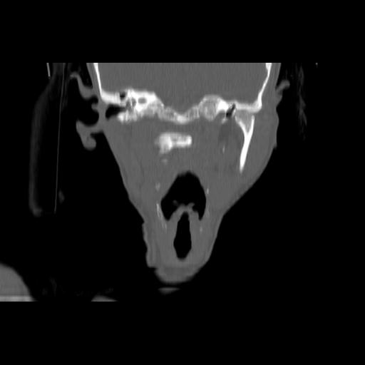 Carcinoma of the maxillary antrum (Radiopaedia 53805-59888 Coronal bone window 87).jpg