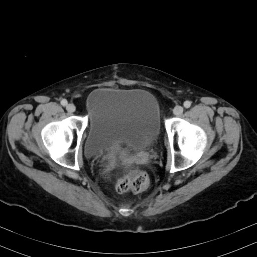 Carcinosarcoma (Radiopaedia 70401-80503 A 62).jpg
