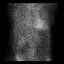Cardiac amyloidosis (Radiopaedia 51404-57239 A 9).jpg