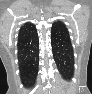 Cardiac sarcoidosis (Radiopaedia 74548-85534 Coronal lung window 58).jpg