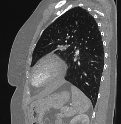 Cardiac sarcoidosis (Radiopaedia 74548-85534 Sagittal lung window 25).jpg