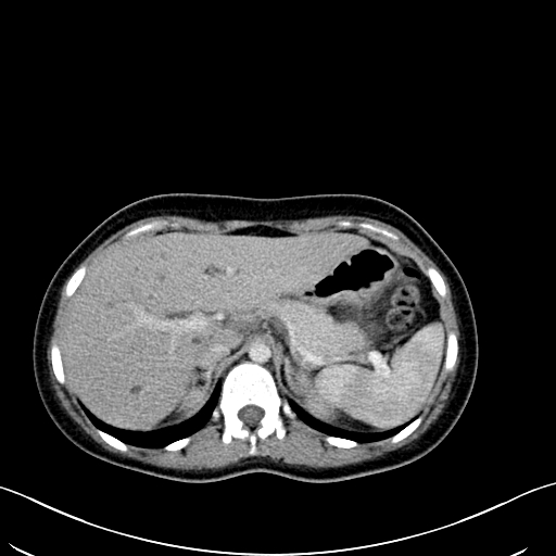 Caroli disease with medullary sponge kidney (Radiopaedia 82622-96804 C 20).jpg