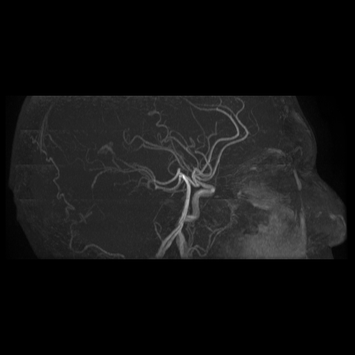 Carotid arterial dissection with acute cerebral infarction (Radiopaedia 26636-26784 MRA 20).jpg