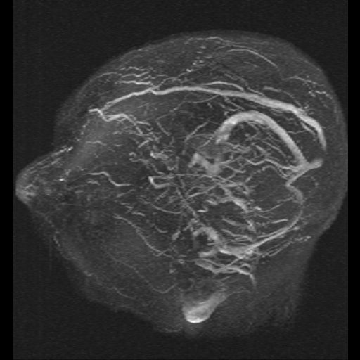 Carotid arterial dissection with acute cerebral infarction (Radiopaedia 26636-26784 MRV 7).jpg