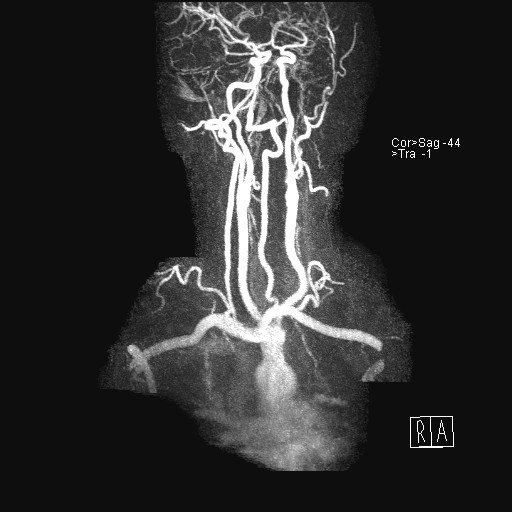 File:Carotid artery dissection (Radiopaedia 28441-28689 MIP Carotids MRA 11).jpg