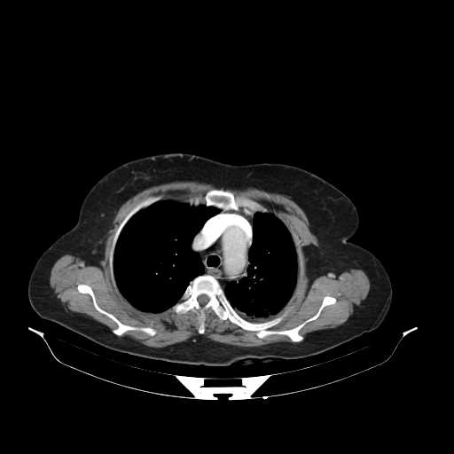 File:Carotid body tumor (Radiopaedia 21021-20948 B 30).jpg