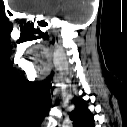 File:Carotid body tumor (Radiopaedia 27890-28124 C 15).jpg