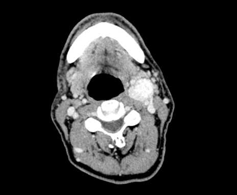 Carotid body tumor (Radiopaedia 61750-69757 Axial Post contrast 45).jpg