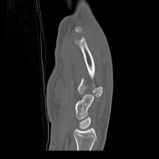 File:Carpo-metacarpal fracture-dislocations with hamatum split fracture (Radiopaedia 18482-18343 Sagittal bone window 14).jpg