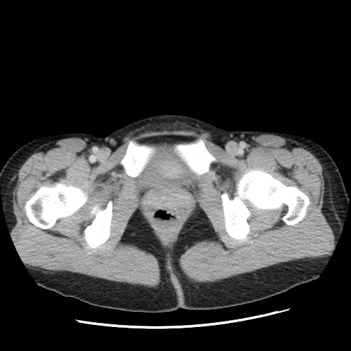 Castleman disease with fibrous pseudotumor in the abdomen (Radiopaedia 77296-89373 A 128).jpg