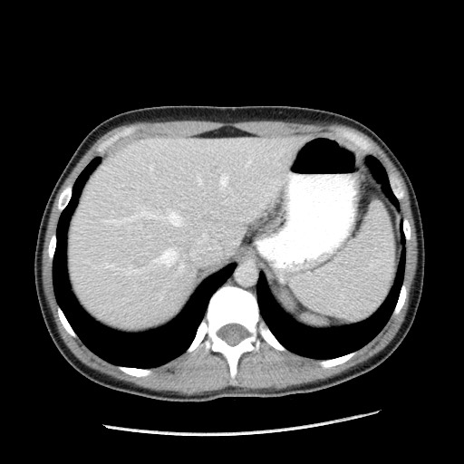 File:Castleman disease with fibrous pseudotumor in the abdomen (Radiopaedia 77296-89373 A 23).jpg