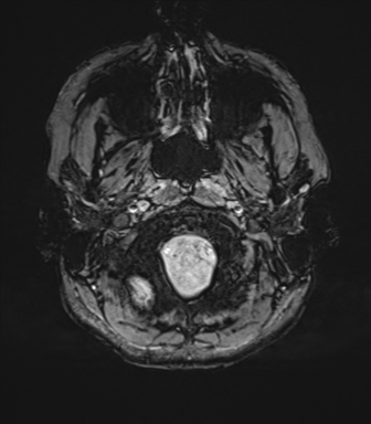 File:Cavernoma with bleed - midbrain (Radiopaedia 54546-60773 Axial SWI 5).png