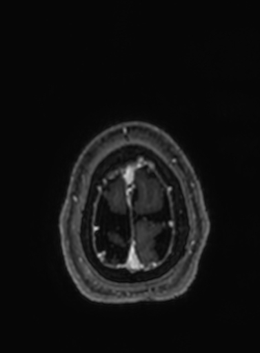 Cavernous hemangioma of the cerebellar falx (Radiopaedia 73025-83724 Axial T1 C+ 29).jpg