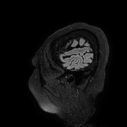 Cavernous hemangioma of the cerebellar falx (Radiopaedia 73025-83724 Sagittal FLAIR 6).jpg