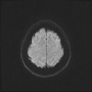 Cavernous sinus meningioma (Radiopaedia 63682-72367 DWI 59).jpg
